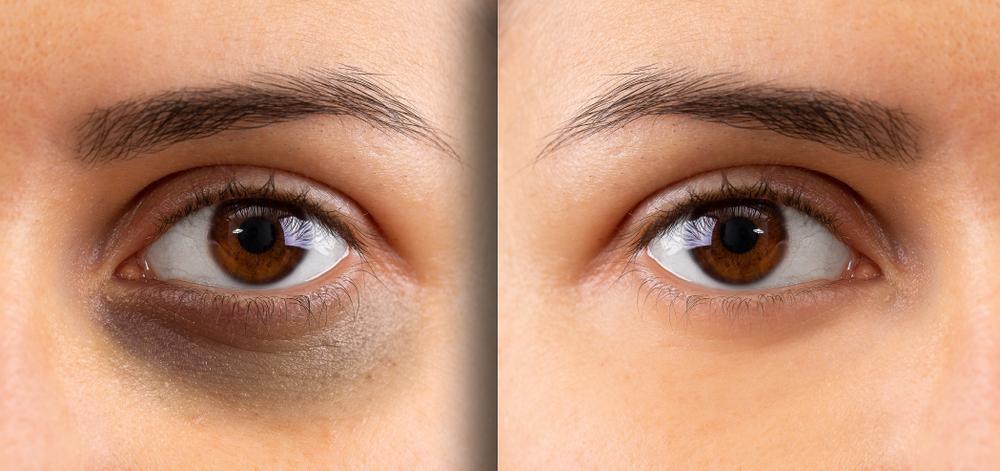 Botox Under Eyes: How To Get Rid Off Dark Circles