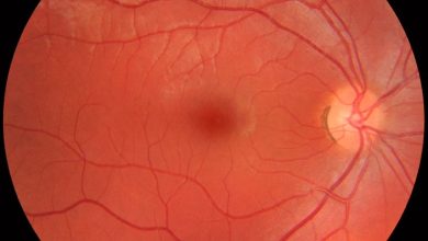 Gene Therapy Breakthrough: New Hope for Leber Congenital Amaurosis Patients 6 Leber Congenital Amaurosis