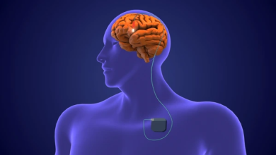 Pacemaker For Brain Offers New Hope for Parkinson's and Depression Treatment 6 Pacemaker for Brain
